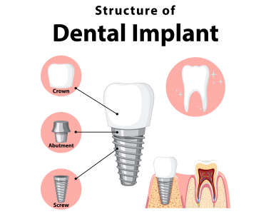 Dental Implants Highland Heights, KY